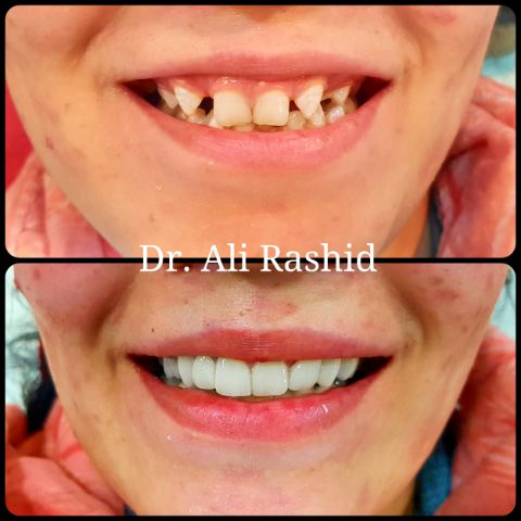 Smile makeover: before and after