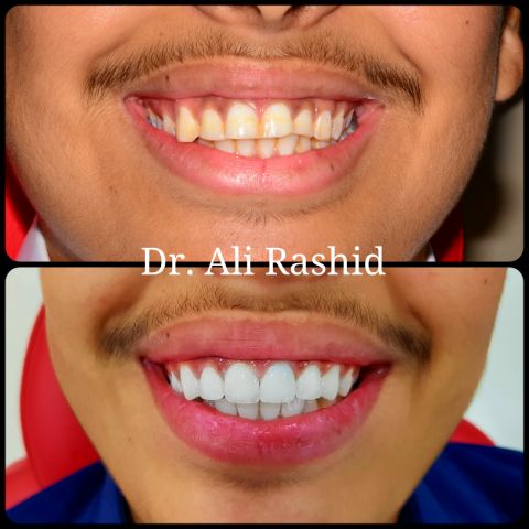 Veneers: before and after