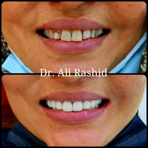 Smile makeover: before and after