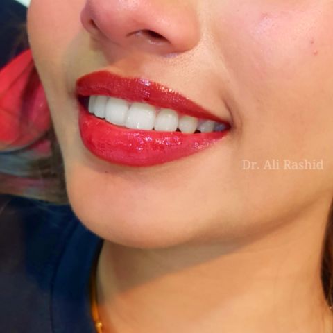 Veneers