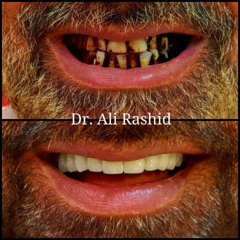 Full smile makeover: before and after