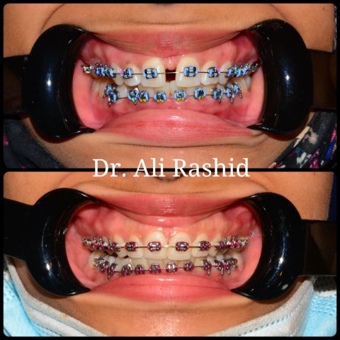 Braces: progress