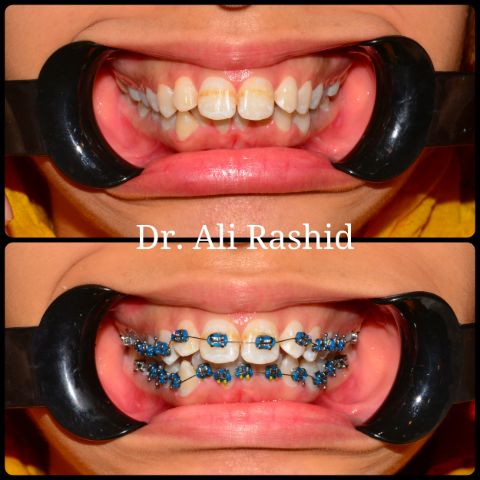 Braces: before and during