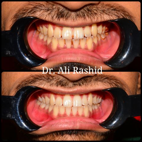 Scaling and polishing: before and after