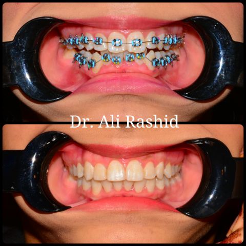 Braces: before and after