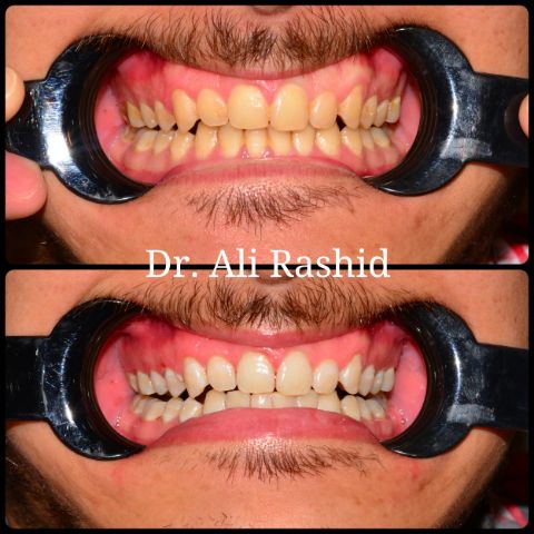 Teeth whitening: before and after