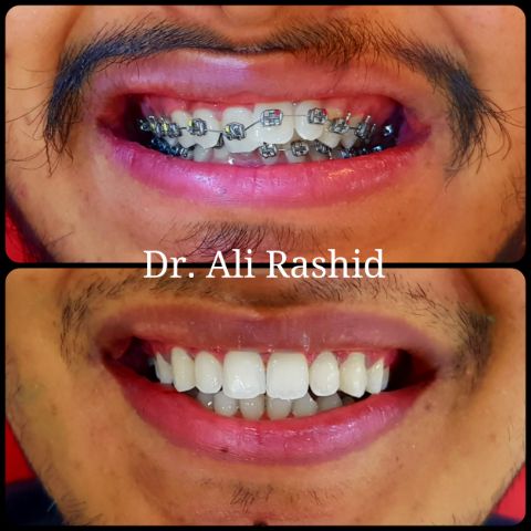 Braces: before and after