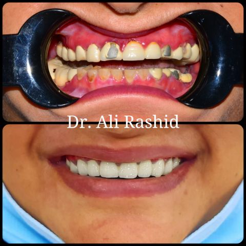 Full smile makeover: before and after