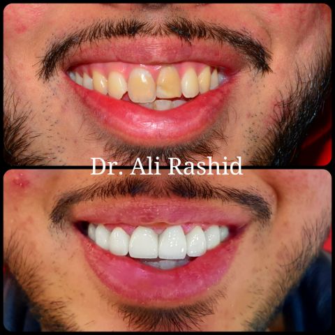 Veneers: before and after