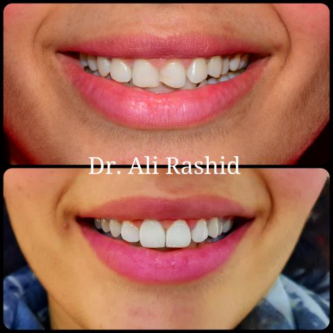 Veneers: before and after