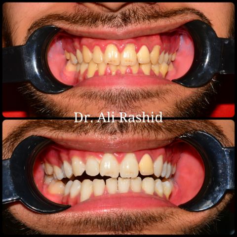 Teeth whitening: before and after